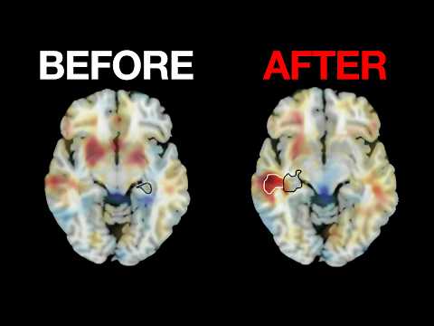 ECT as a Treatment for Resistant Depression in Mental Health