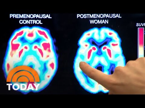 Navigating Menopause Brain Fog Through Mental Health Strategies