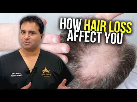 Mirtazapine and Hair Loss: A Mental Health Perspective