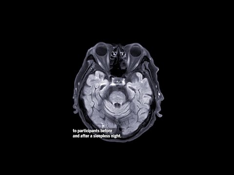 Sleep Deprivation: A Controversial Approach to Depression Treatment