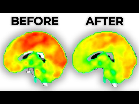 Side Effects of Antidepressants and Their Mental Health Impact