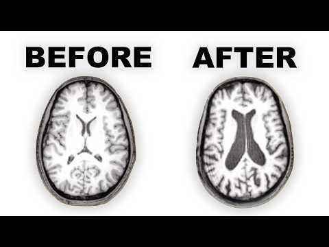 Is Olanzapine a Risk for Addiction in Mental Health Treatment?
