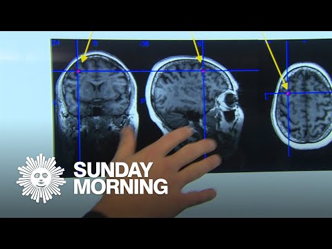 Magnetic Stimulation: A New Hope for Depression Relief