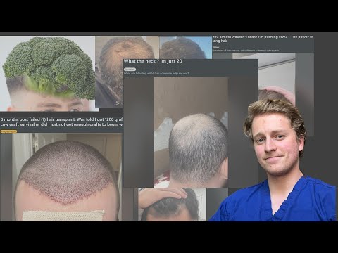 Mirtazapine and Hair Loss: Mental Health Perspectives on Reddit